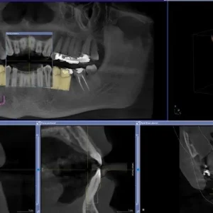 Chairside/Labside Implants CEREC/InLab/Exocad